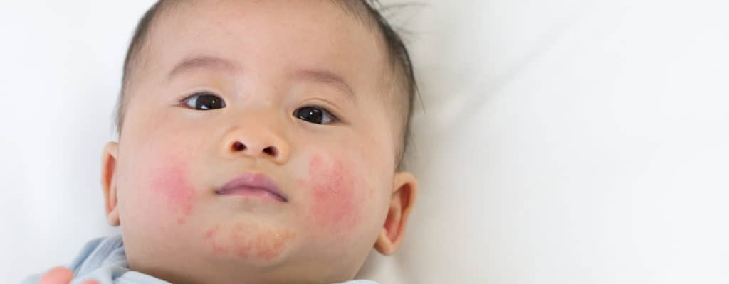 what-causes-a-rash-around-the-mouth