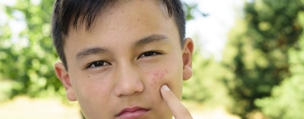 Späte Pubertät bei Jungen: Ursachen und Behandlung