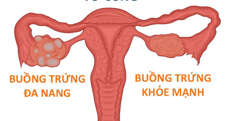 多嚢胞性卵巣症候群の女性は妊娠できますか？