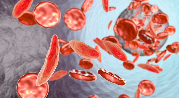 Symptoms when your child has sickle cell anemia