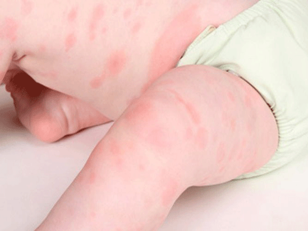 Should spend 3 million as an allergy test for your baby?