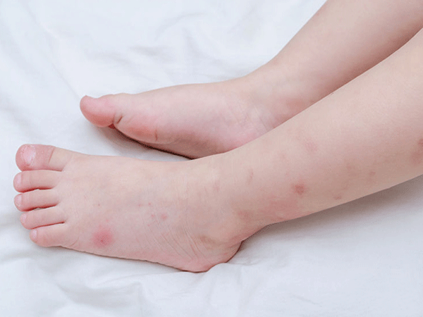 腫れのない蚊に刺された場合の治療方法、赤ちゃんのすべての傷跡
