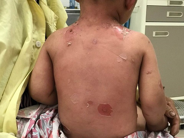Garçon de 2 ans souffrant dulcères systémiques à cause dun bain de cigarette