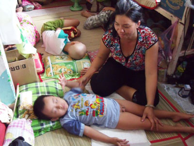 Preschool physical development: Hemiplegia syndrome