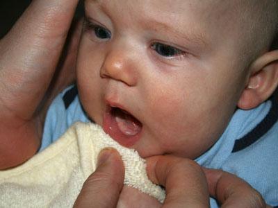 Breastfeeding: The baby has a thrush
