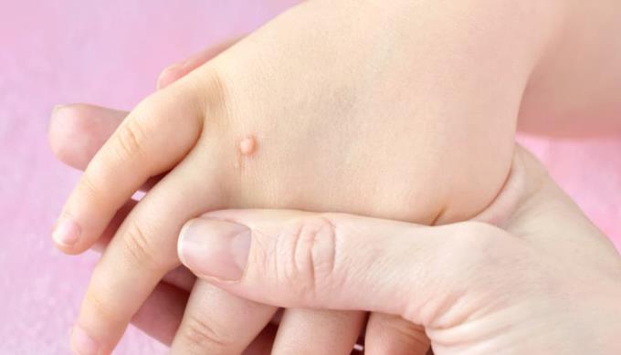 Hautkrankheiten bei Kindern sind häufig und wie man sie verhindert