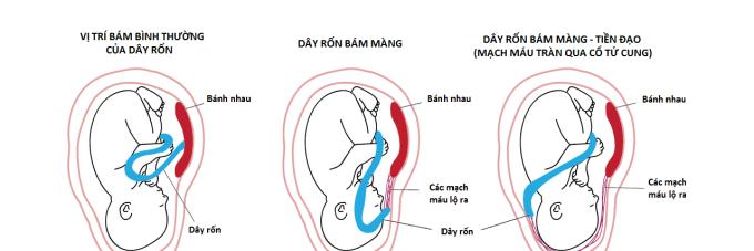 Přilnutí pupečníku k membránám: Těhotenské komplikace by se neměly brát na lehkou váhu