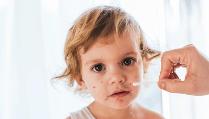 Wie man Akne bei Kindern sehr effektiv behandelt, kann man ausprobieren