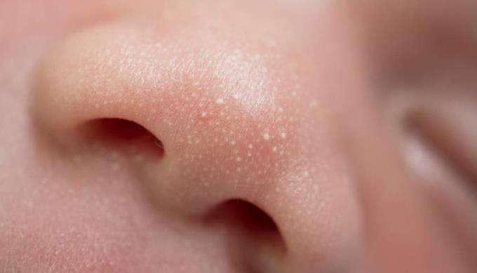 Skin diseases in babies: Mother knows early to treat the baby!