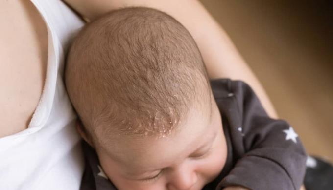 Kožní onemocnění u miminek: Matky včas rozpoznají, že mají kojence léčit!