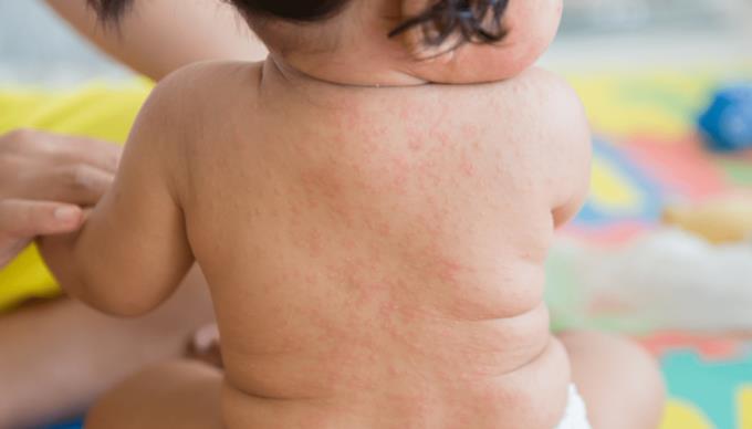 Child's fever rash: When should parents worry?