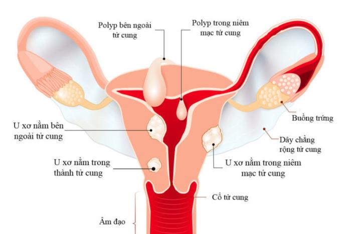 Účinky děložních myomů na těhotenství a porod