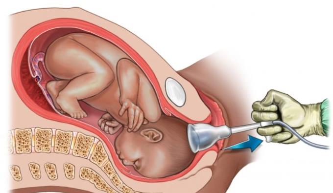 Ризици са којима се беба може суочити приликом порођаја са вакуумском чашом