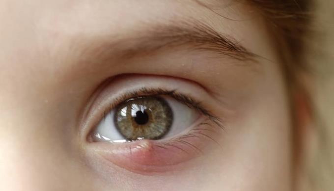 Glaukom u dětí: příznaky, příčiny a léčba
