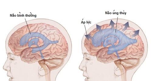 Neonatal hydrocephalus: orsaker, tecken och behandling