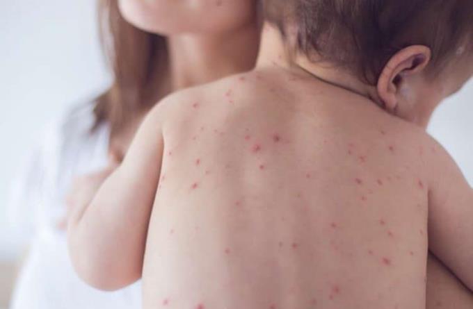 Distinguishing between typhus and dengue fever for proper child care