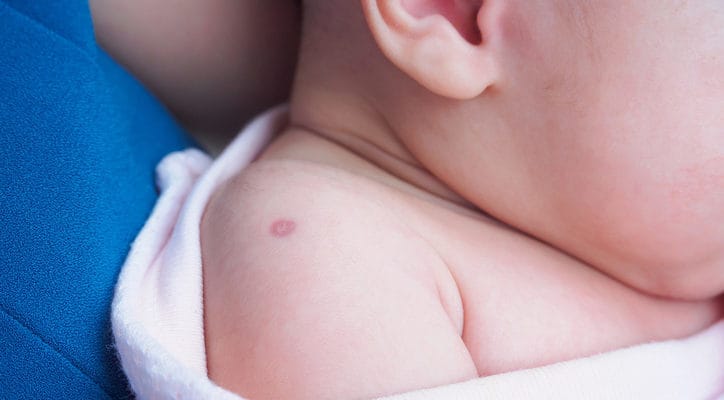 Vaccinazione antipolio per i bambini