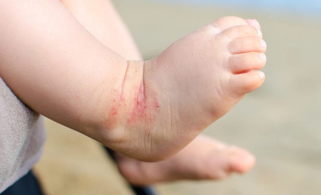 La vitamina D può curare l'eczema nei bambini