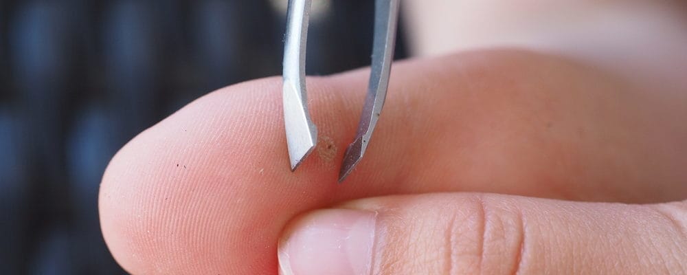 Parents should know how to get a splinter properly so as not to cause bad consequences