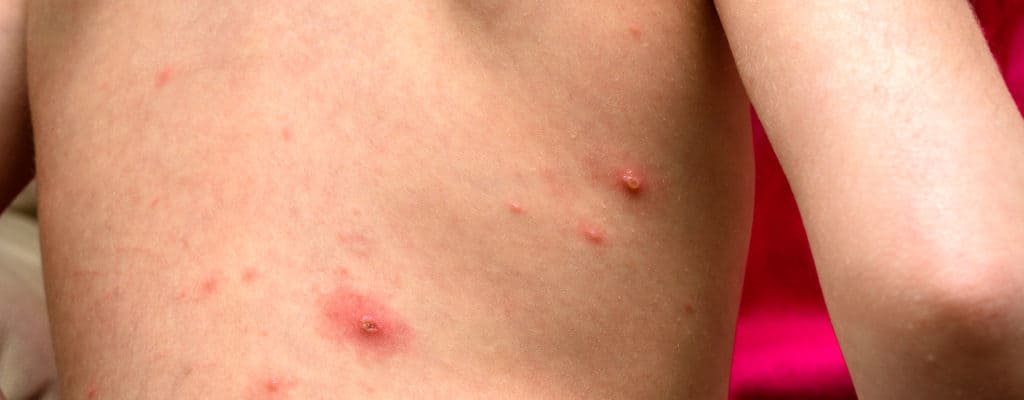 Sai come trattare l'herpes zoster a casa per il tuo bambino?