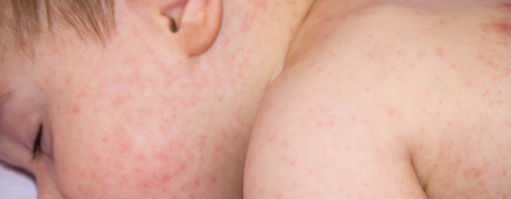 Častá kožní onemocnění u dětí