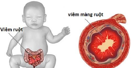 Rješenje za djecu koja ne dobivaju na težini zbog malapsorpcije