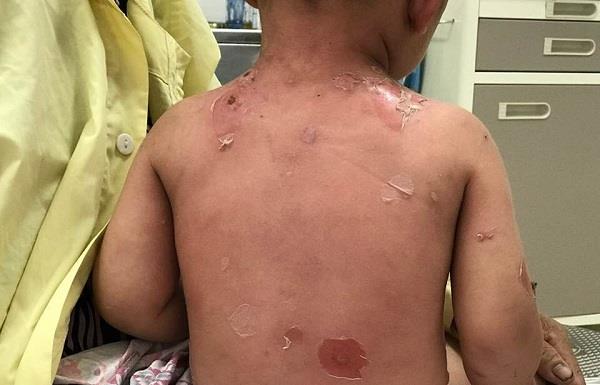 Bambino di 2 anni con ulcere sistemiche a causa di un bagno di sigaretta