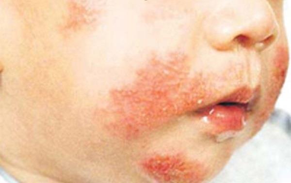 Be careful with dermatitis in babies