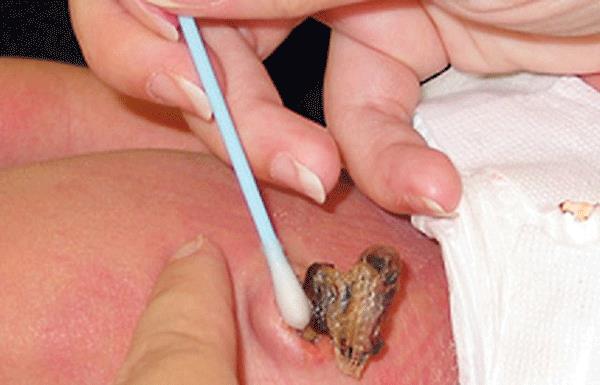 The umbilical cord of a newborn baby has a bad smell, bleeding & pus